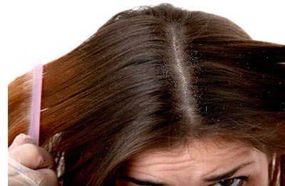 Cách trị chăm sóc tóc gàu bằng thiên nhiên hiệu quả từ lá thông