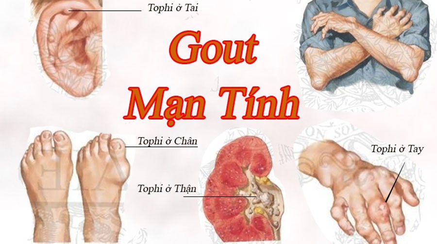 Chế độ ăn uống cho người mắc bệnh gout