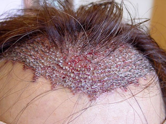 Nguyên nhân và cách trị gàu cho da đầu,